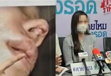 女网红隆鼻惨变“猪鼻” 鼻子烂出一个洞