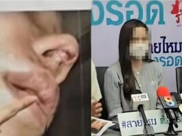 女网红隆鼻惨变“猪鼻” 鼻子烂出一个洞