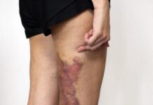女子艾灸遭店家擅自拍痧 腿部淤青久不消还被额外收费